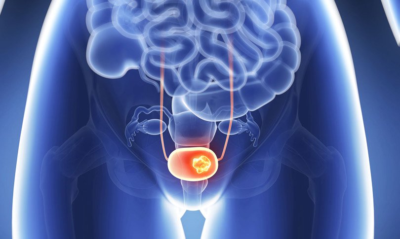 ब्लडर क्यान्सर के हो ? जानौं यसको ९ तथ्य