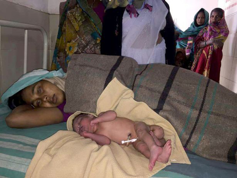 भारतमा जन्मियो दुई योनांग र चार खुट्टा भएको बच्चा